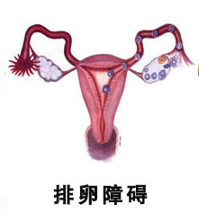 卵巢排卵障礙