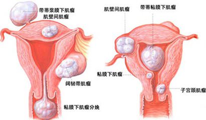 产后子宫肉瘤