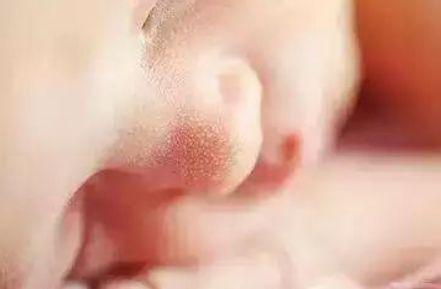 【家家母婴】10种新生儿皮肤问题，月嫂别慌，正确护理是关键